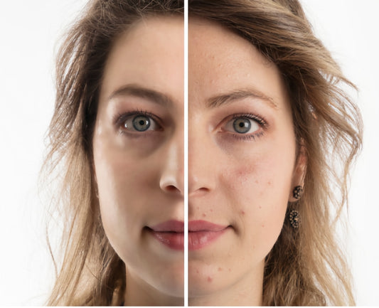 Acne before & after